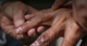 2025 இல் ஆயிரத்திற்கும் மேற்பட்ட தொழுநோயாளர்கள் பதிவு